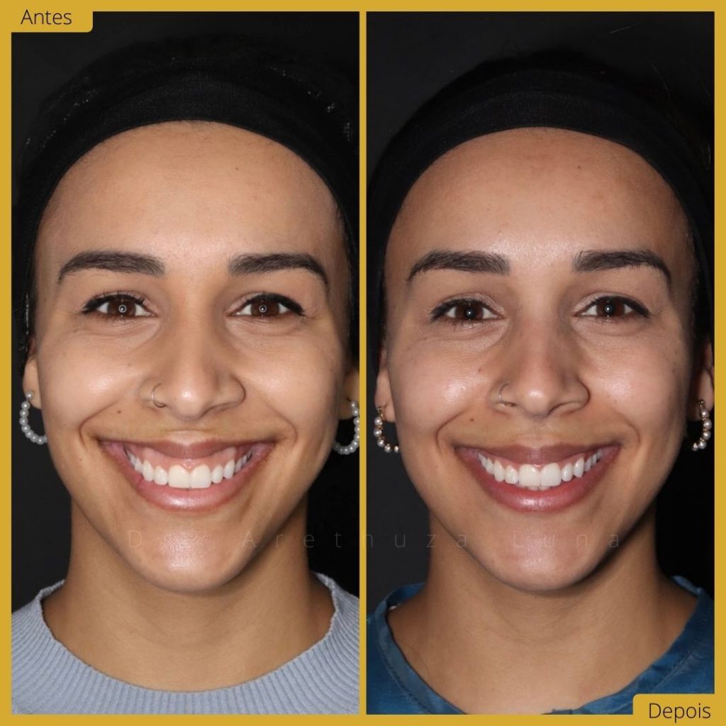 botox