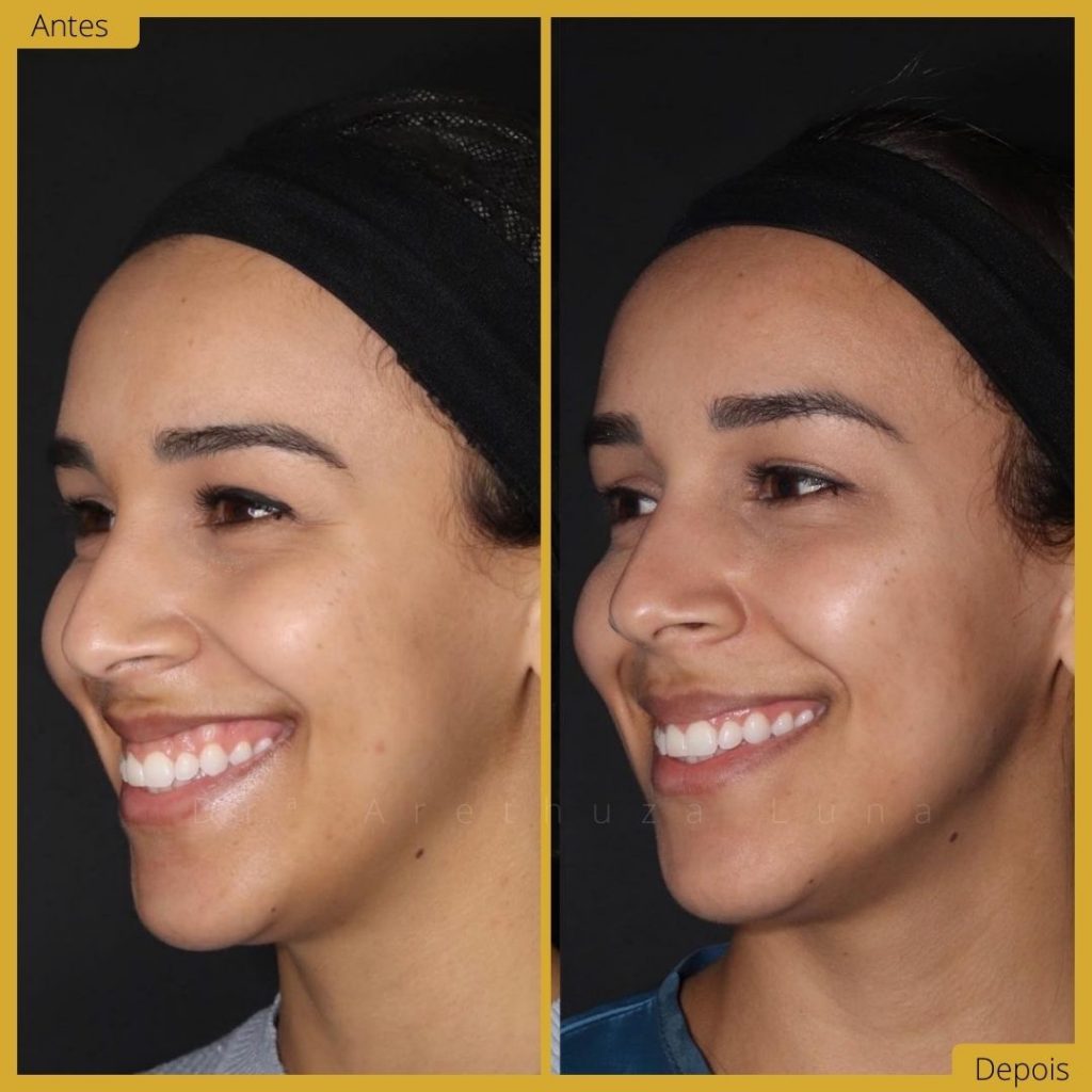botox