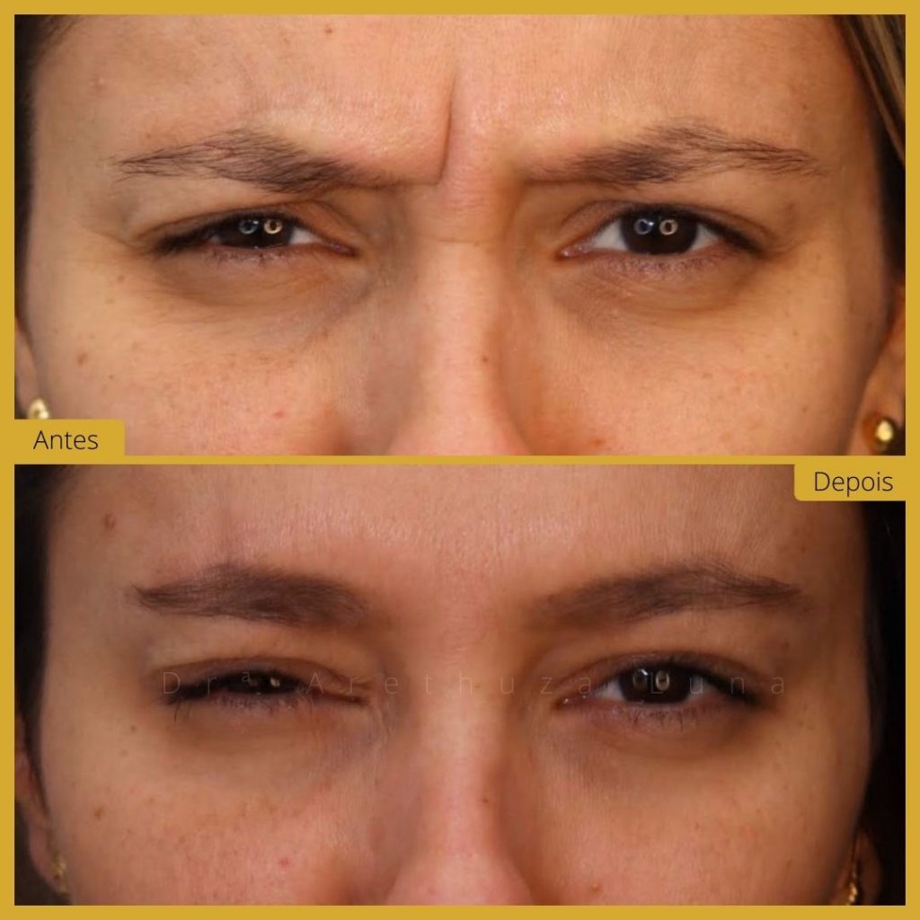 botox