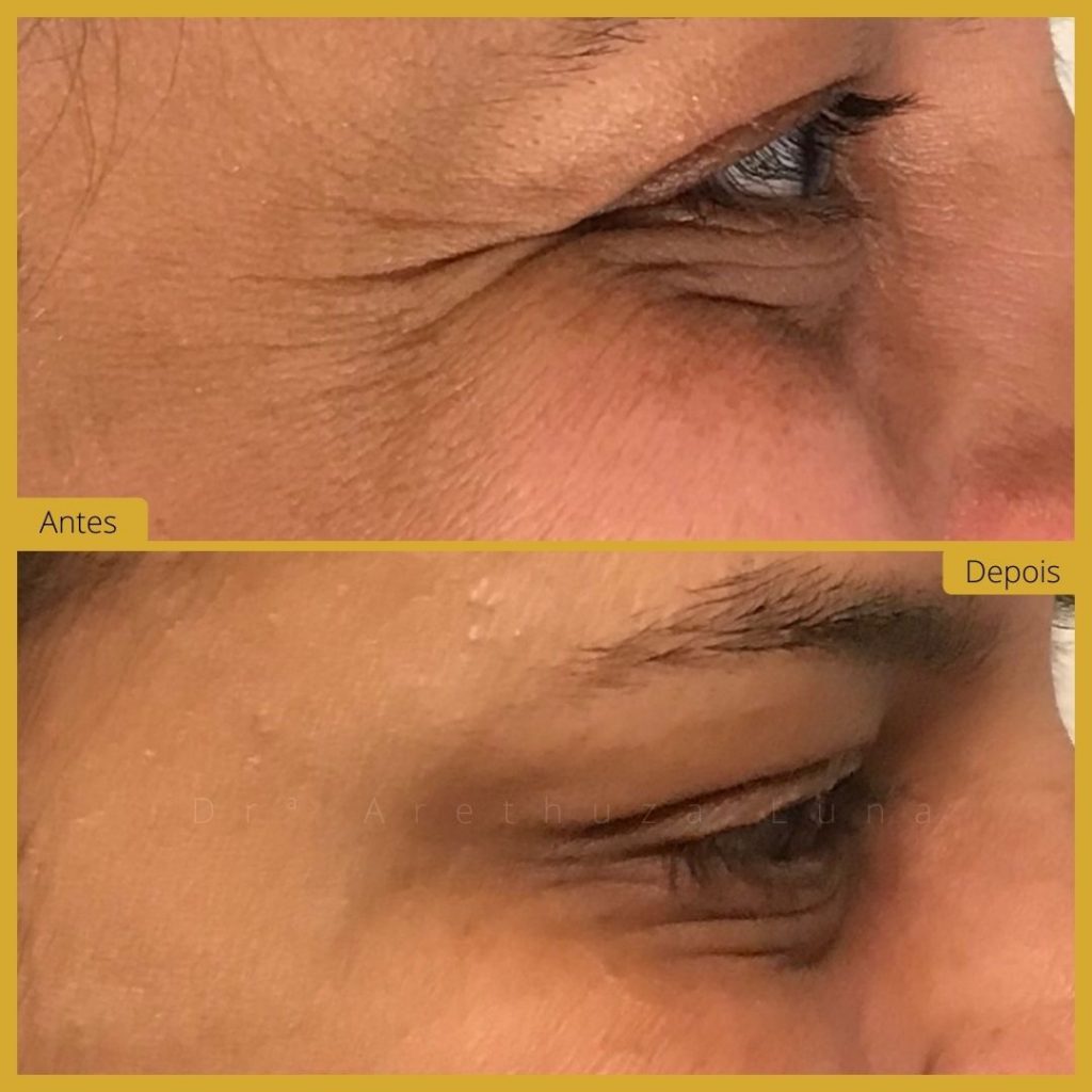 botox