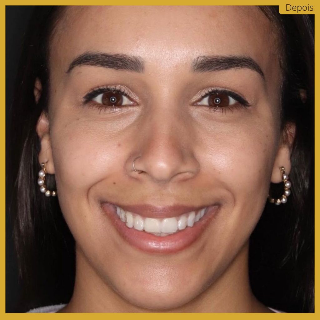 Botox