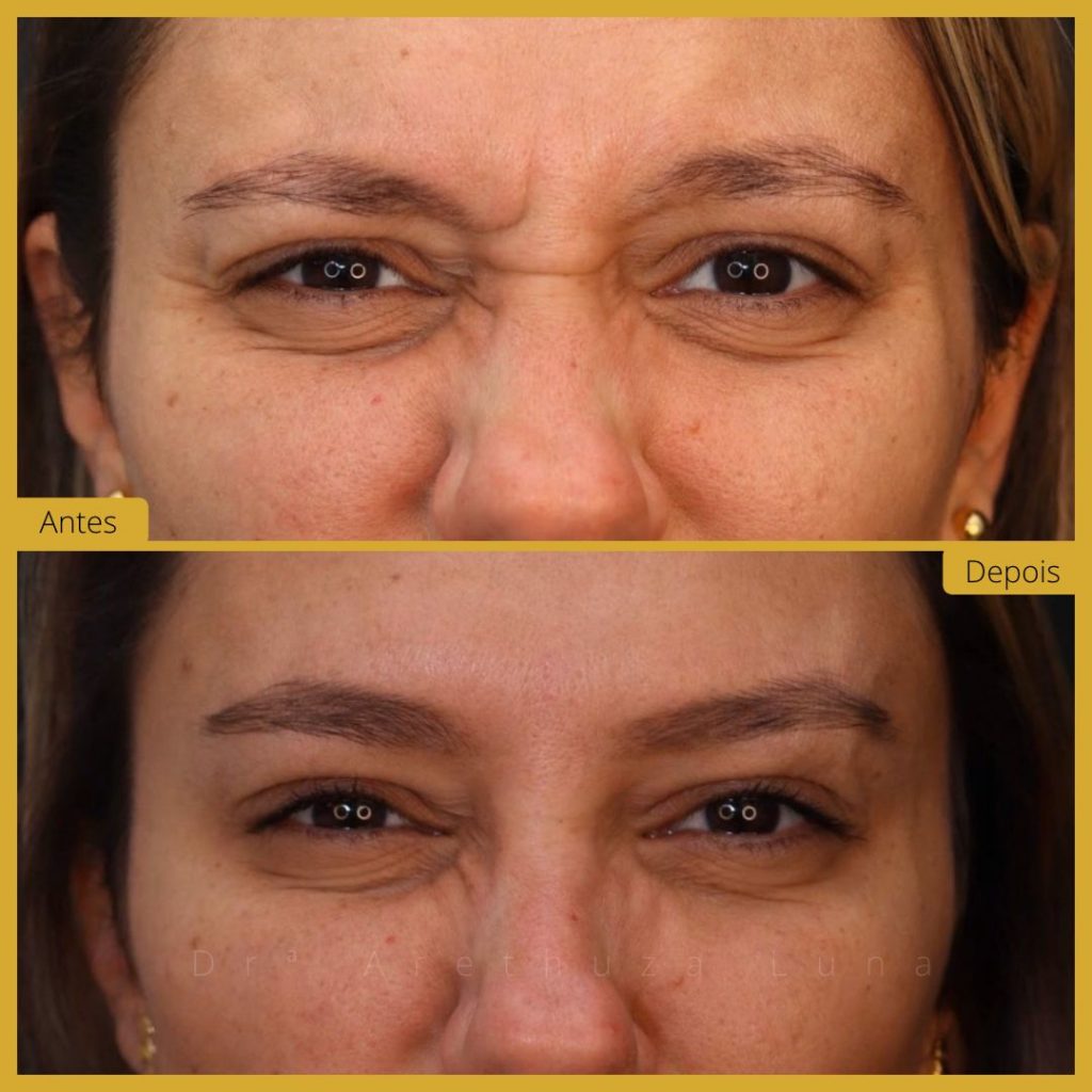 Botox