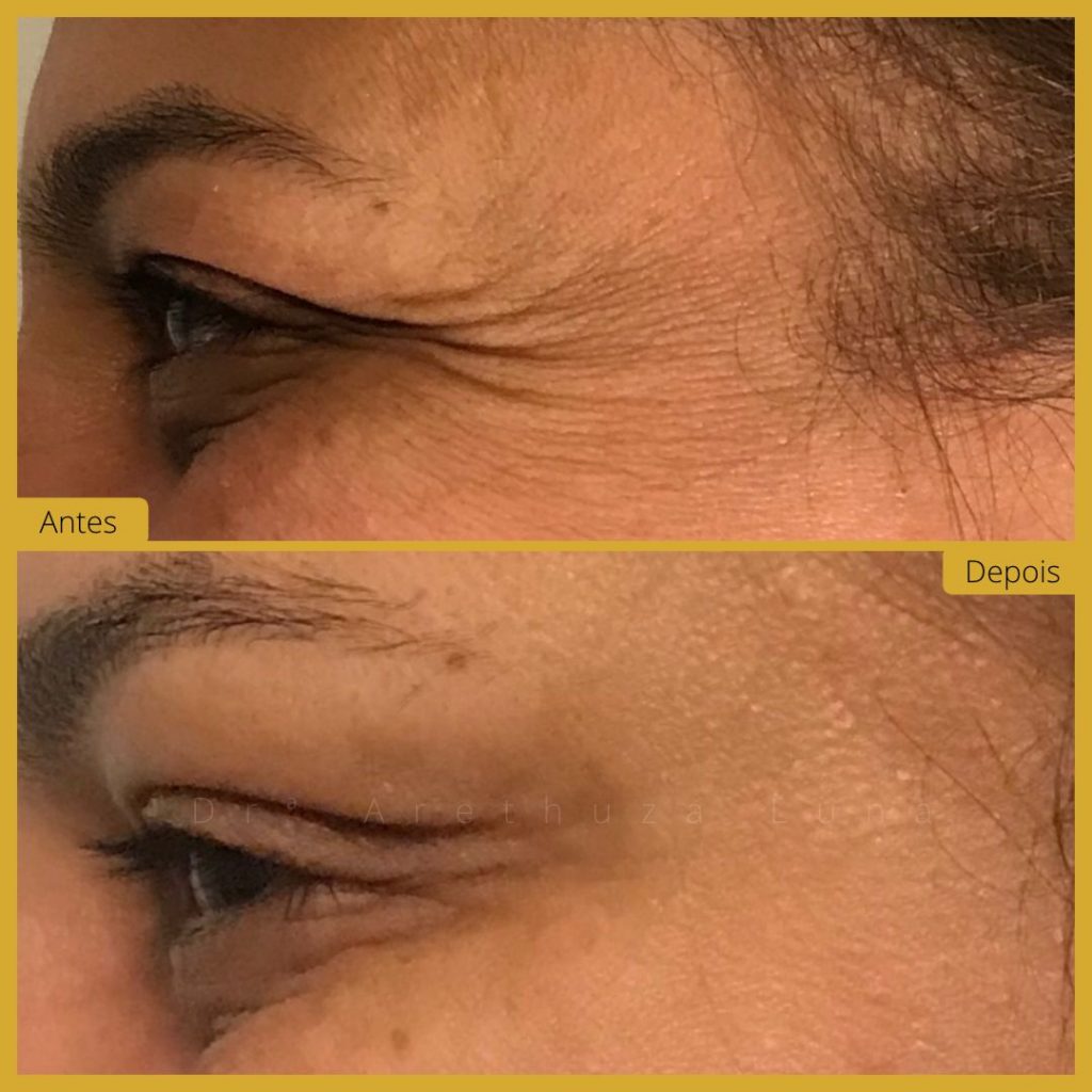 botox