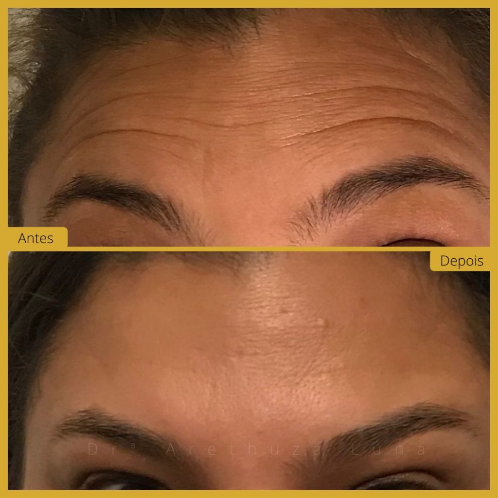 botox