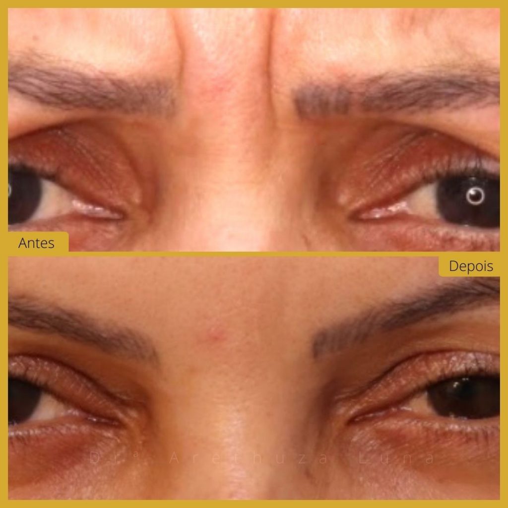 Botox - Caso 8