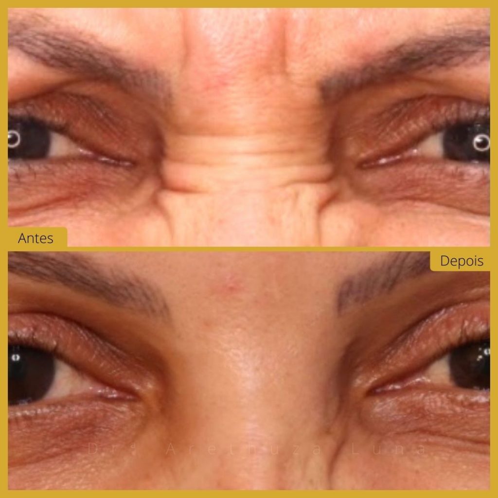 Botox - Caso 8