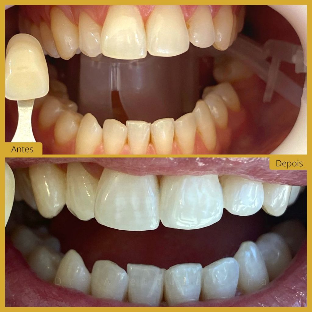 Branqueamento dentário – Caso 5