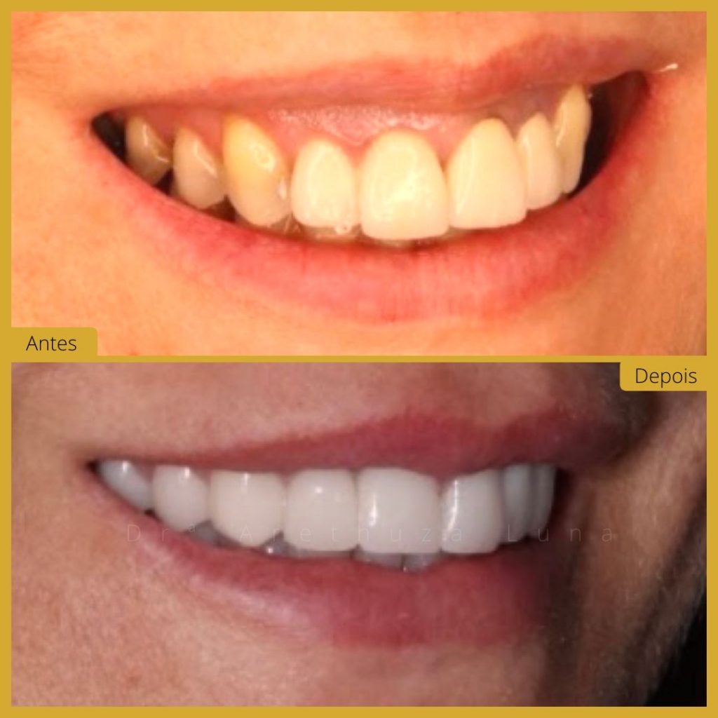 facetas dentárias