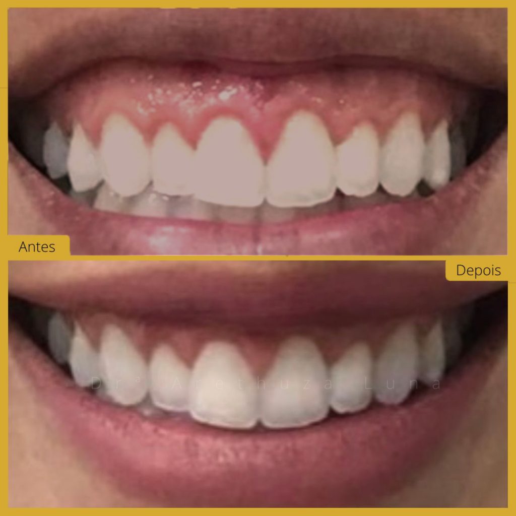 Botox Caso 6